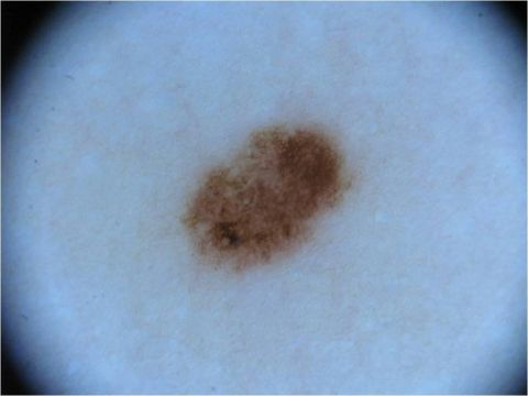 A photo of a pigmented skin lesion