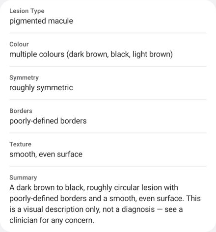 Sunny's six-field output: lesion type, colour, symmetry, borders, texture, and a summary ending with the non-diagnosis safety line